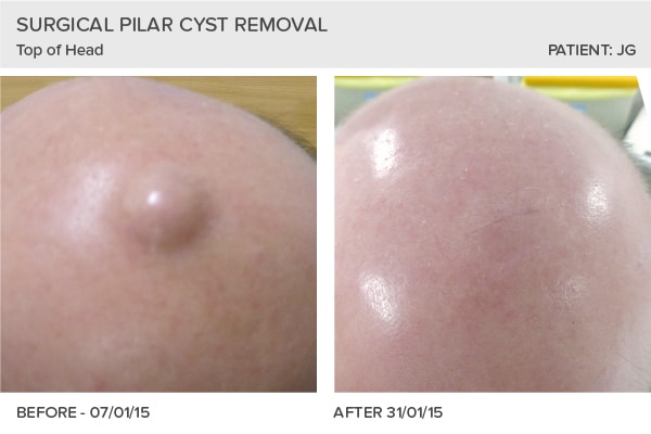Epidermoid and pilar cysts (sebaceous cysts) - WebMD Boots
