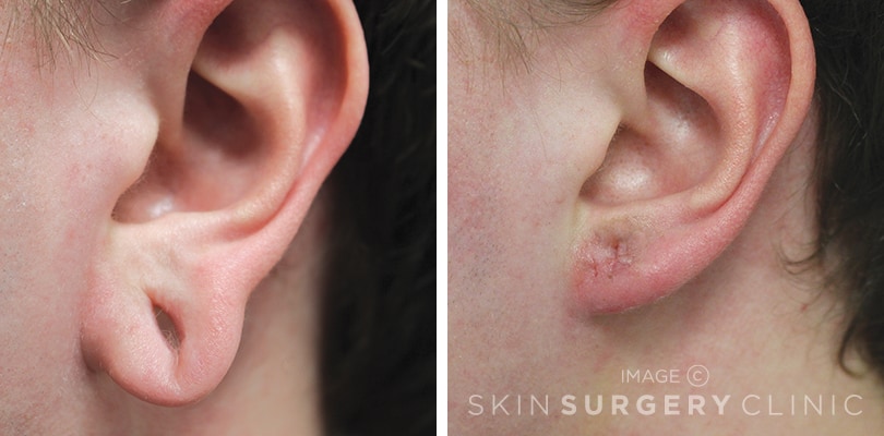 Stretched Earlobe Reconstruction