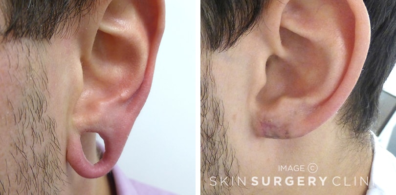 Stretched Earlobe Reconstruction