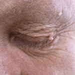 Skin Tag Removal - Before