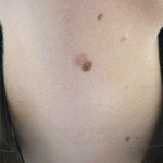 Skin Tag Removal - After