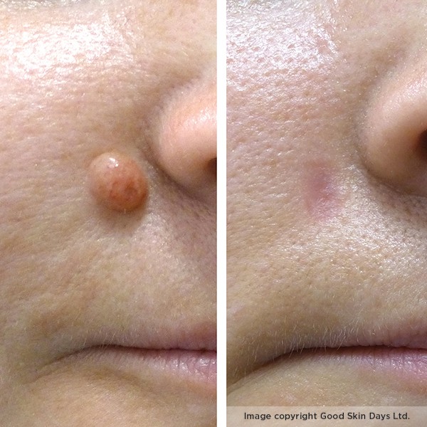 Facial Mole Removal Success Story   Cosmedics Skin Clinics