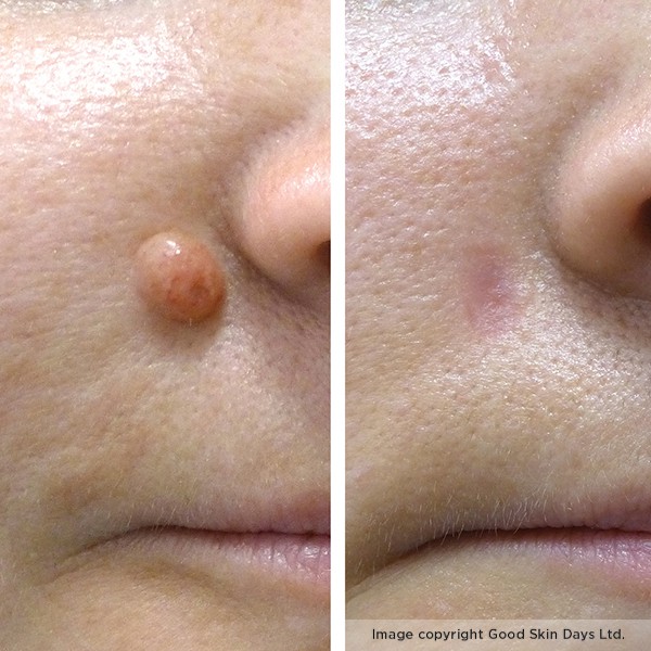 The Ugly Truth About Mole Removal