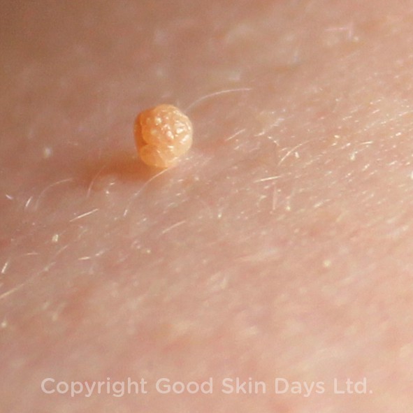 Top 103+ Images Skin Tags And Warts Photos Latest 09/2023