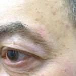 Seborrhoeic Keratosis Removal - After
