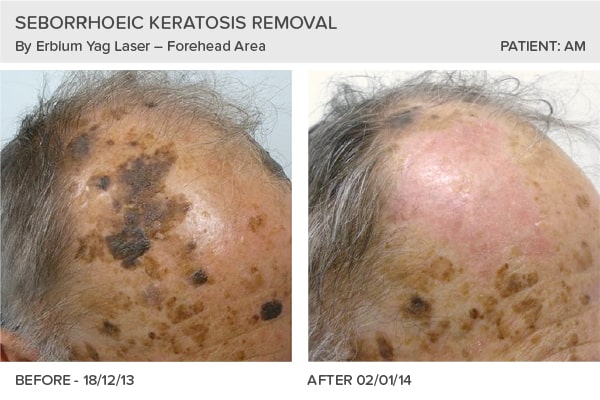 Seborrheic Keratosis Laser Treatment Cost MAMC Seborrheic Keratosis Laser Treatment Cost MAMC