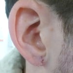 Stretched Earlobe Reconstruction - After
