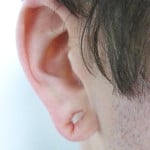 Stretched Earlobe Reconstruction - Before