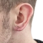 Stretched Earlobe Reconstruction - After