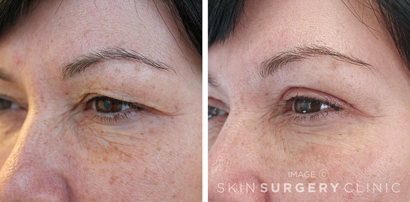 Upper Blepharoplasty Eyelid Surgery in Leeds and Harrogate - Before and After