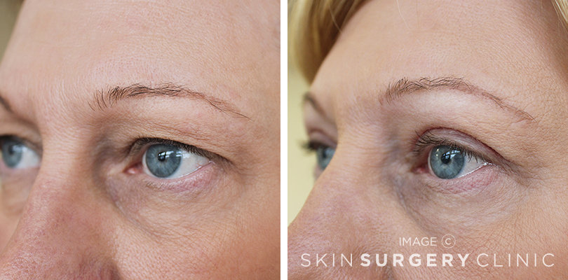 Upper Blepharoplasty Eyelid Surgery in Leeds and Harrogate - Before and After