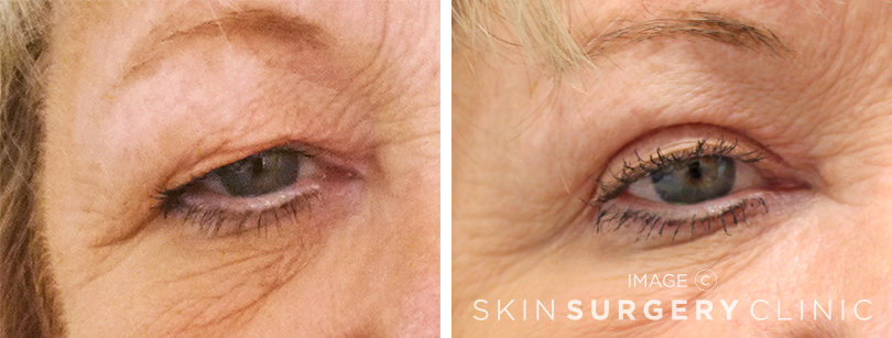 Upper Blepharoplasty Leeds before and after pictures