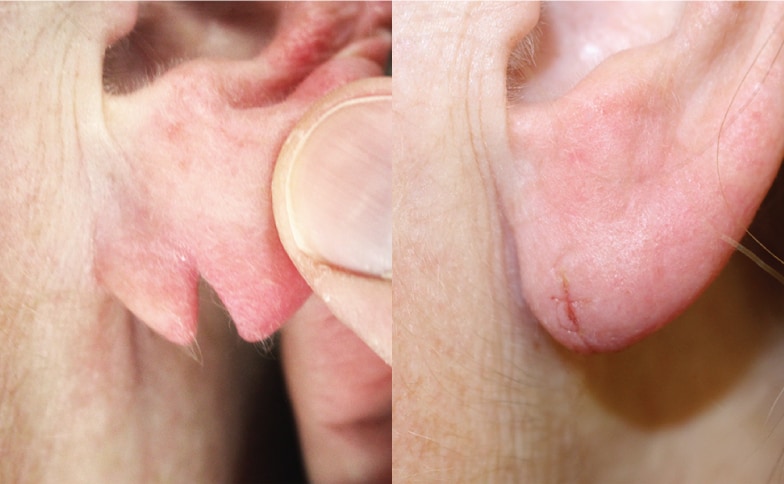 Split Earlobe Repair Removal Leeds and Harrogate - Before and After