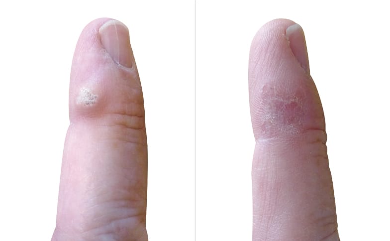 Beginning Of Warts On Hands