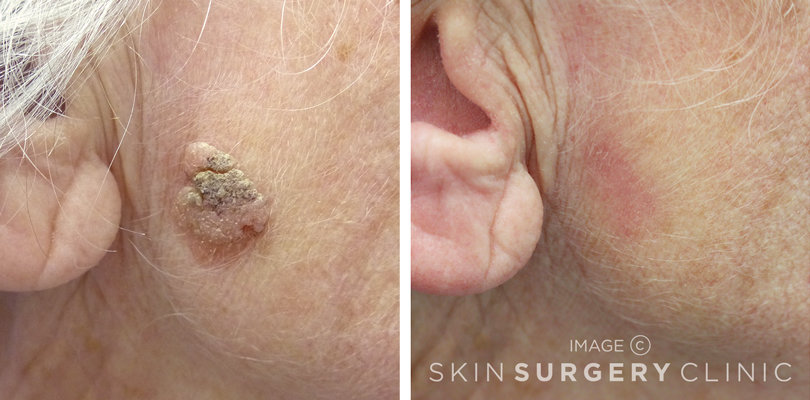 Seborrheic Keratosis Face Removal Seborrheic Keratosis Pennsylvania Seborrheic Keratosis Face Removal Seborrheic Keratosis Pennsylvania