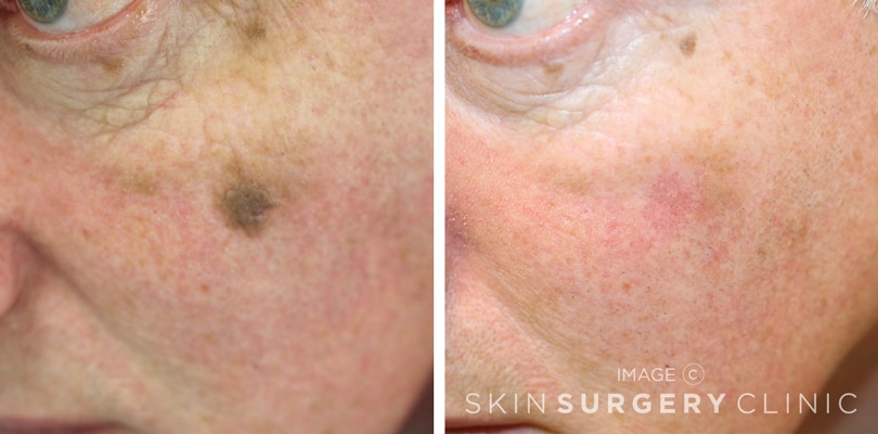 Seborrhoeic Keratosis Removal Leeds and Harrogate - Before and After Photos