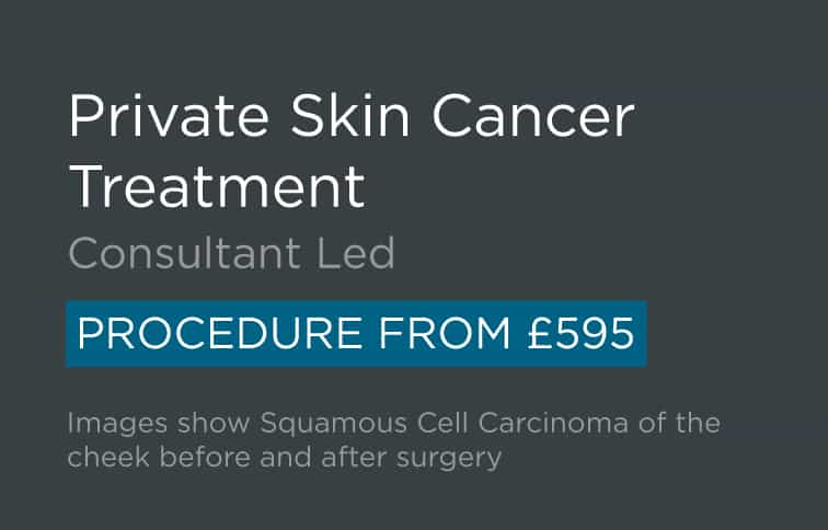 Private Skin Cancer Treatment BCC SSC Leeds Bradford Harrogate Yorkshire