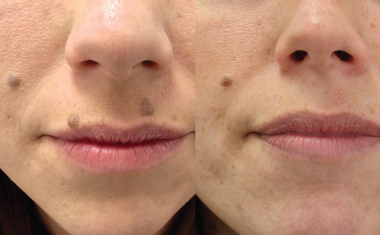 Mole Removal Leeds and Harrogate - Before and After