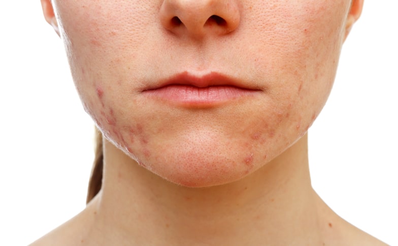 Acne Treatment in Leeds - Private Dermatologist Leeds and Bradford