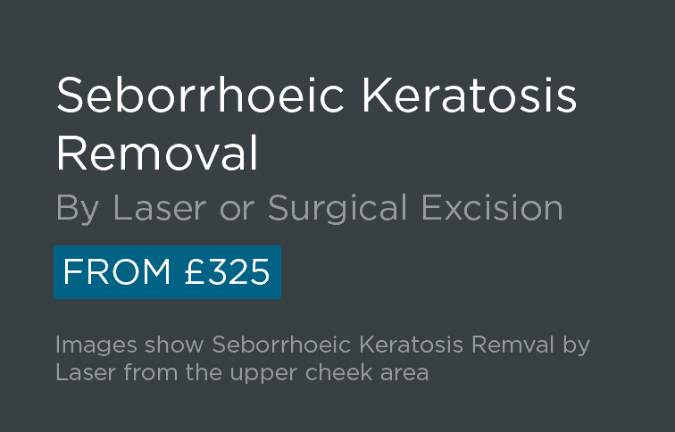 Seborrhoeic Keratosis Removal Leeds and Harrogate - Introduction