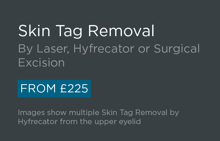 Skin Tag Removal Leeds and Harrogate - Introduction