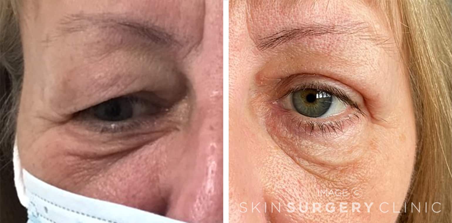 Upper Blepharoplasty Leeds before and after pictures