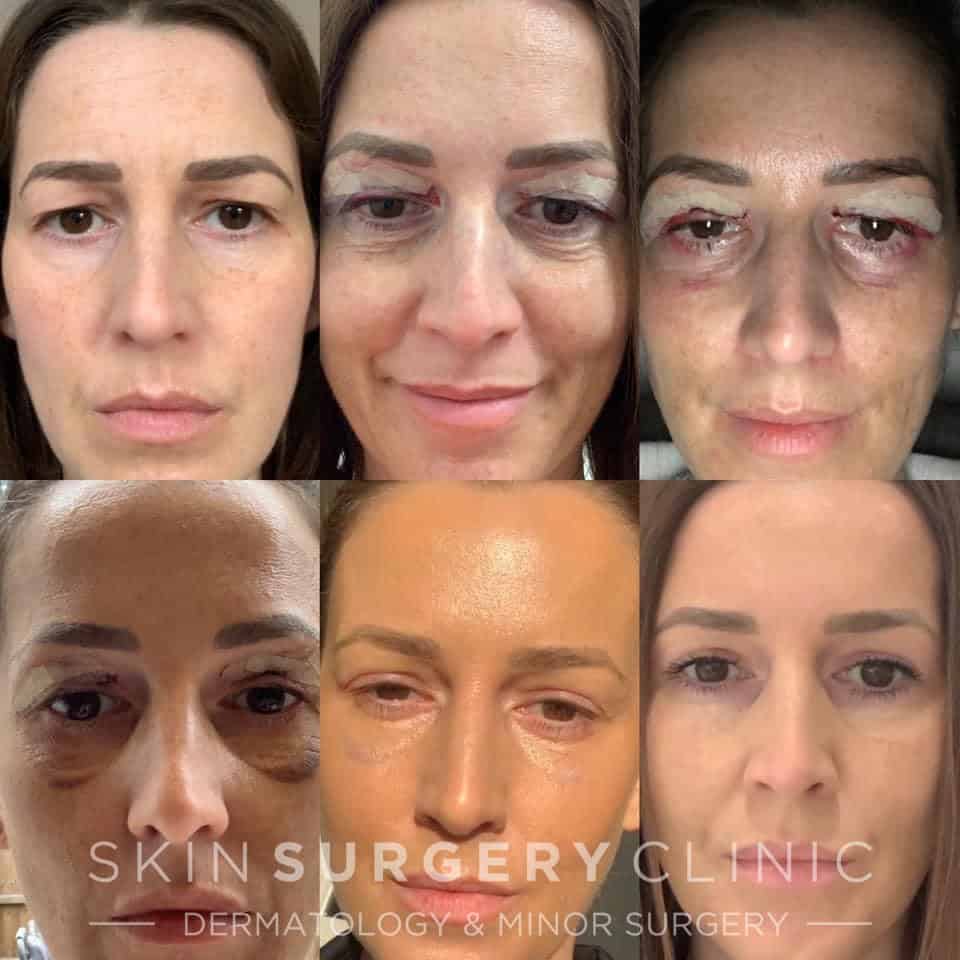 Upper eyelid hot sale surgery recovery