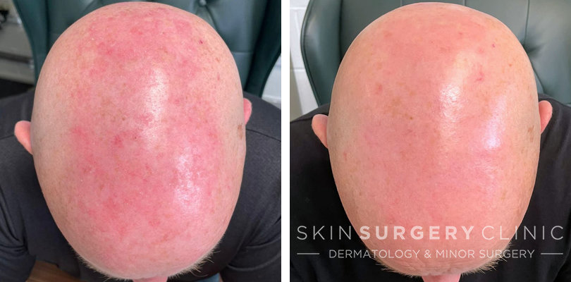 Dermatology Treatment in Leeds - Sun Damage to Skin on Head