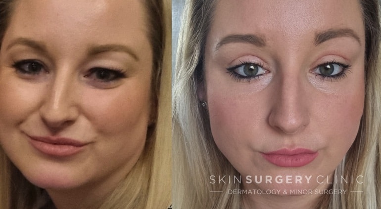 Kirsty's Eyelid Surgery Story: Before and Four Weeks After