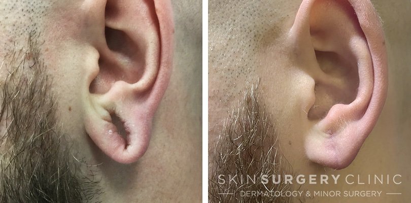 Earlobe Reconstruction Leeds Bradford work before and after
