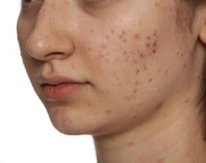 Acne - Skin Surgery Clinic