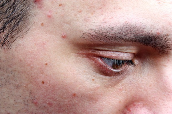 Dermatological disease acne pimples on the face of a man