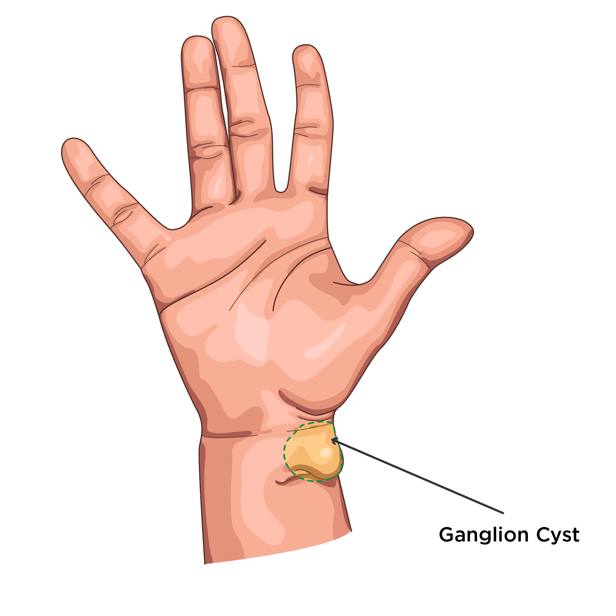Hand Wrist Surgery In Leeds Skin Surgery Clinic Hand Wrist Surgery In Leeds Skin Surgery Clinic