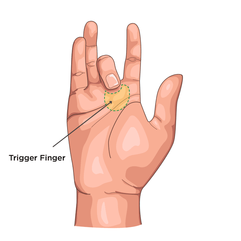 Hand & Wrist Surgery in Leeds - Skin Surgery Clinic