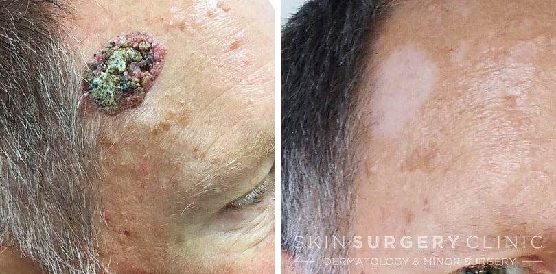 Seborrheic Keratosis Face Removal Seborrheic Keratosis Pennsylvania Seborrheic Keratosis Face Removal Seborrheic Keratosis Pennsylvania