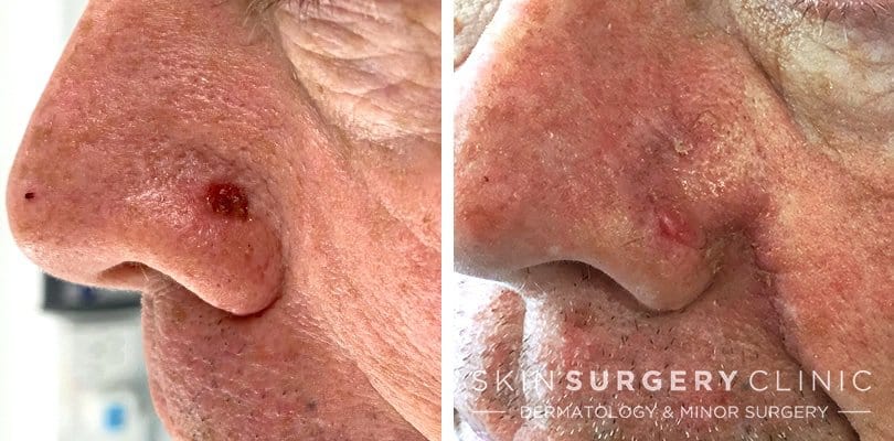 Basal Cell Carcinoma Nhs Basal Cell Carcinoma Nhs