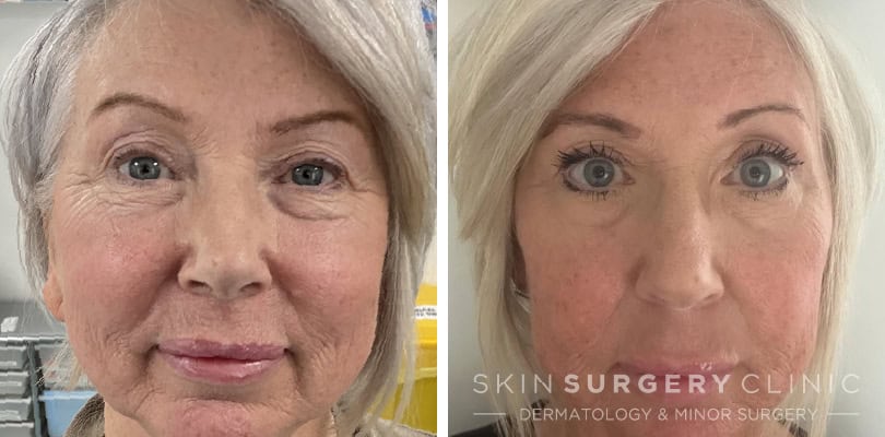 upper blepharoplasty patient story MF