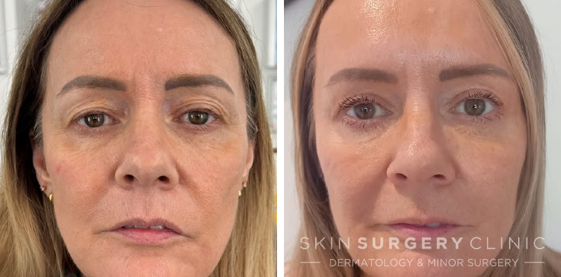 upper blepharoplasty patient story Karen