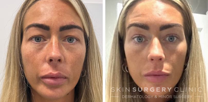 KJ Upper blepharoplasty before and after