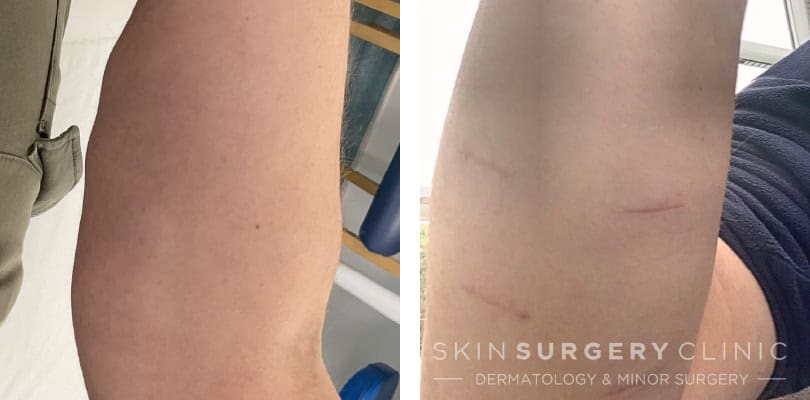 lipoma removal PA patient story -