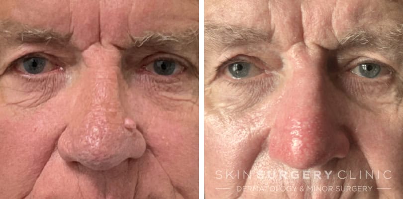 rhinophyma surgery DG patient story