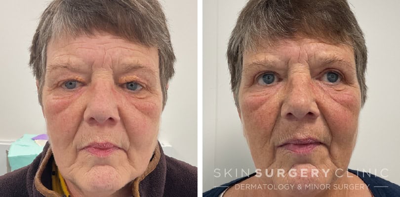 upper blepharoplasty before and after AW