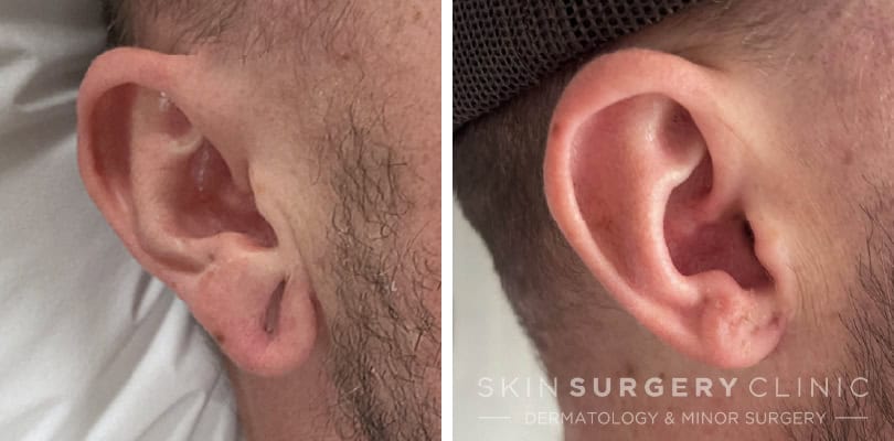 stretched earlobe reconstruction Jordan Nunas patient story -