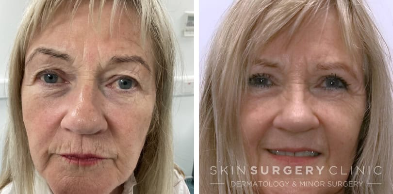 upper blepharoplasty julia king patient story before and after-
