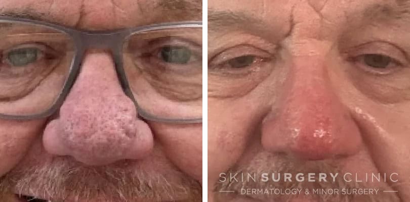 rhinophyma michael devaney before and after rhinophyma michael devaney before and after