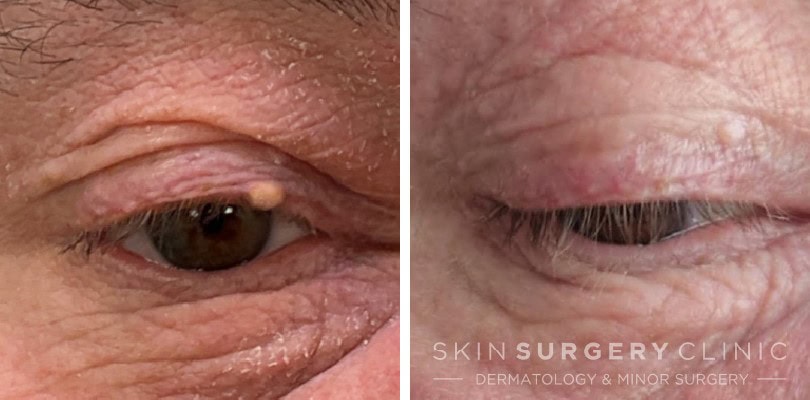 Cyst Removal Sebaceous Cyst Removal