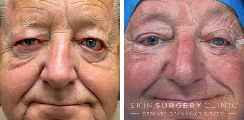 Lower Blepharoplasty Surgery Lower Blepharoplasty Surgery before and after pictures