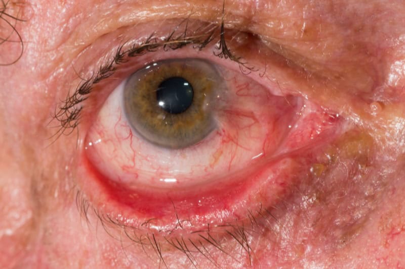 Eyelid Ectropion Surgery