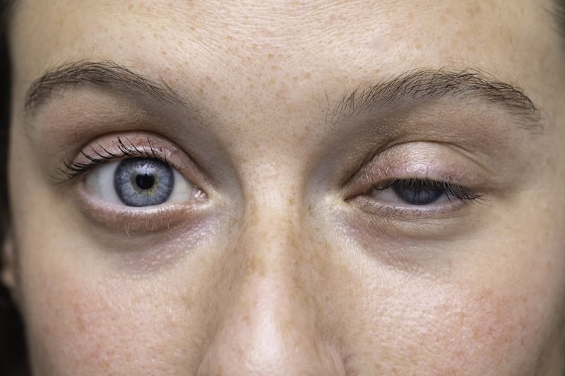 Eyelid Ptosis Surgery