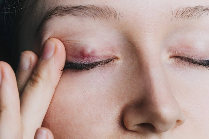 chalazion removal surgery